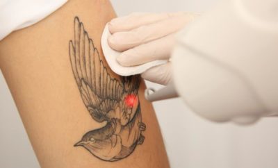Power of Laser Tattoo Removal