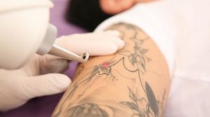 Understanding Laser Tattoo Removal